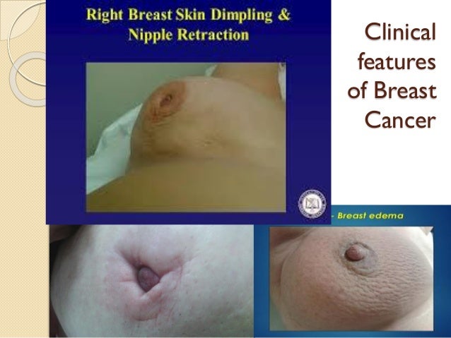 brest nipple retraction breast cancer Brest nipple retraction breast cancer
